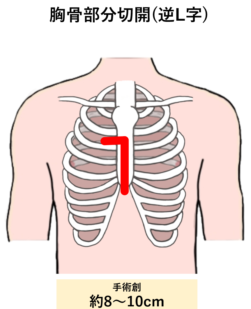 胸骨部分切開（逆L字）