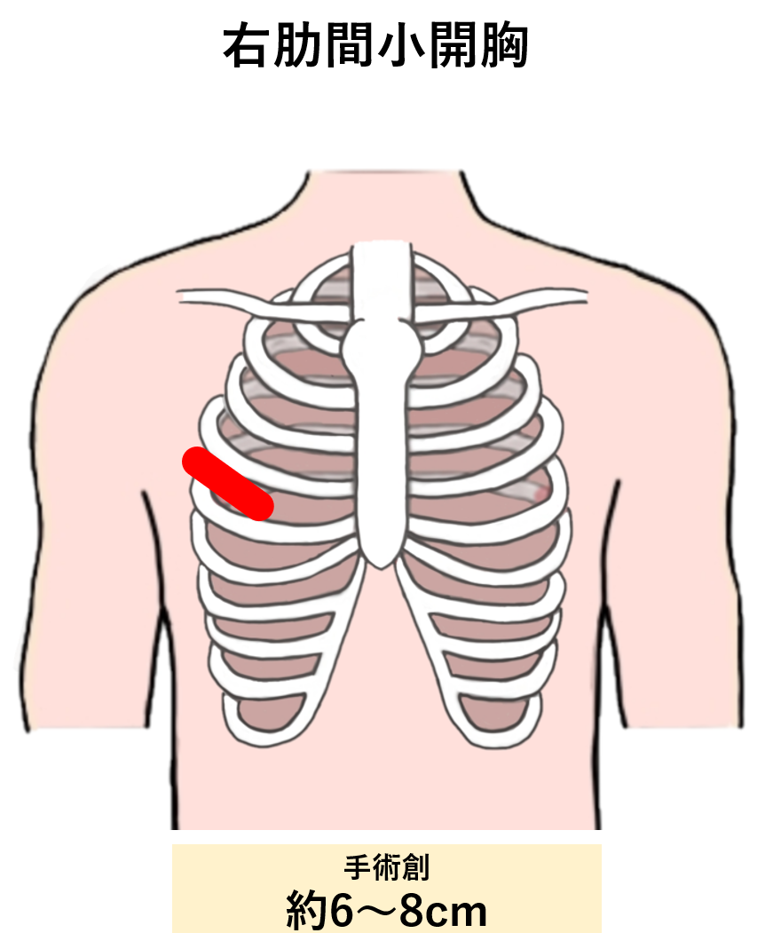 右肋間小開胸