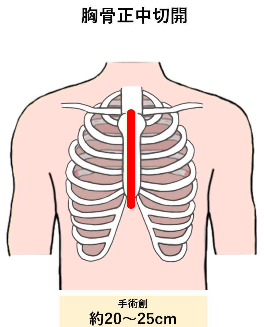 胸骨正中切開
